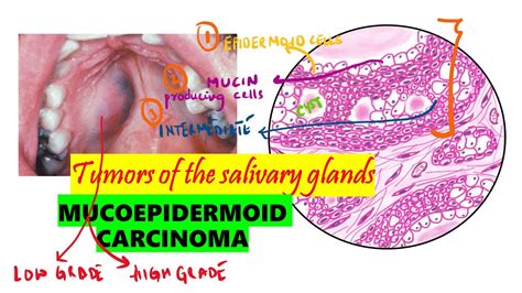 Mucoepidermoid carcinoma Histopathology | Clinical features | DETAILED ...