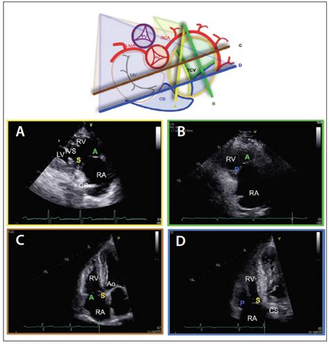 Echocardiography for Tricuspid Valve Intervention - Cardiac ...