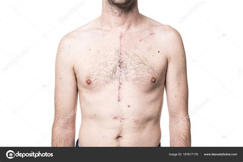 Some Scar from open heart surgery in studio — Stock Photo © Lopolo ...