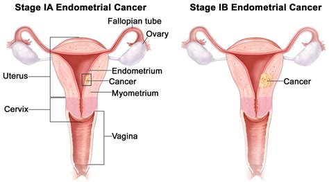 Endometrial Cancer - Causes, Early Signs, Symptoms, Treatment