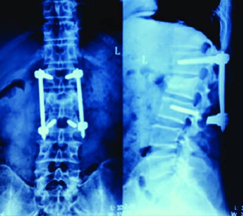 Male, 43 years old, L3 vertebral fracture (type A3): screw breakage at ...