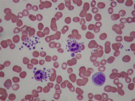 Iron deficiency anemia and clumping Platelets | Cardiac Health