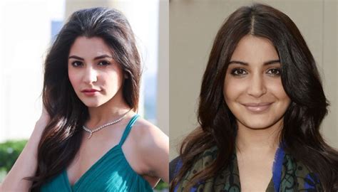 Anushka Sharma Nose Job