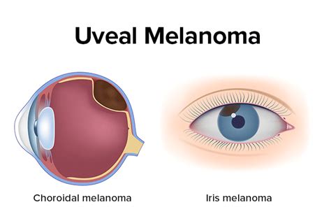 Choroidal Melanoma