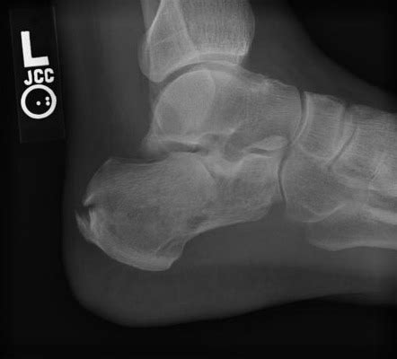 Calcaneal fracture | Radiology Reference Article | Radiopaedia.org