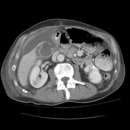 Gallbladder perforation | Radiology Reference Article | Radiopaedia.org