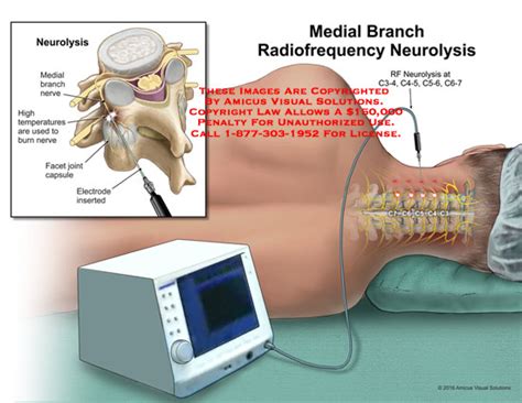 Medial Branch Radiofrequency Neurolysis