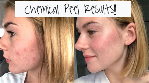 I Got a Chemical Peel!!! The Results: - YouTube