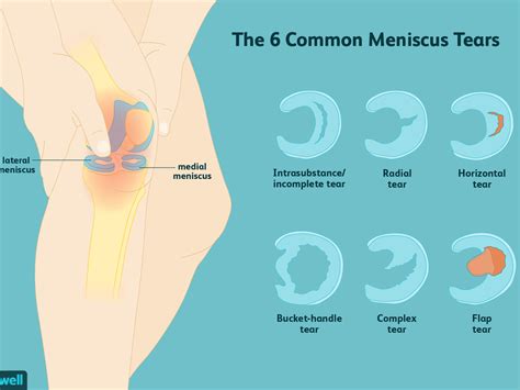 Can A Meniscus Tear Heal On Its Own? - Melbourne Physio Clinic ...