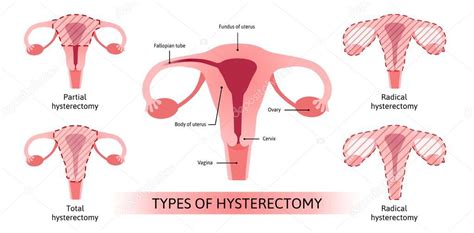 Histerectom a, extirpaci n quir rgica del tero. La ilustraci n del ...