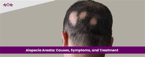 Alopecia Areata: Causes, Symptoms, Treatment & How to Stop it?