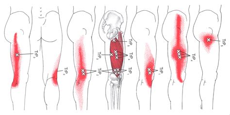 Vastus Lateralis | The Trigger Point & Referred Pain Guide