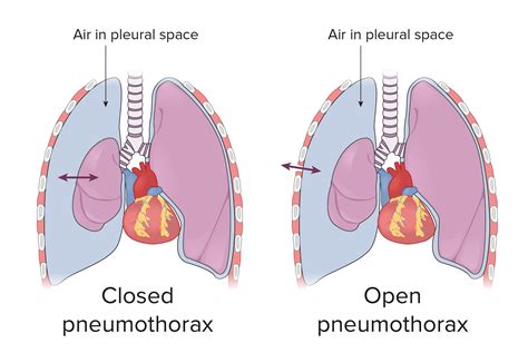 Pneumothorax | Concise Medical Knowledge