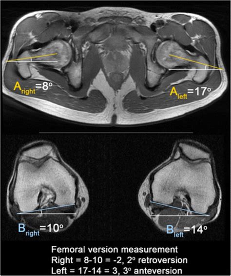 1 Calculation of femoral version corrected for distal femoral rotation ...