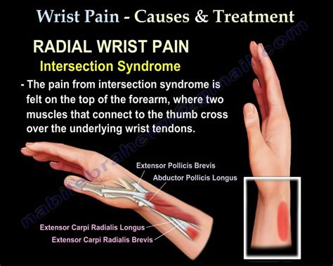 Ulnar Sided Wrist Pain Diagnosis And Treatment - Captions Trending Update