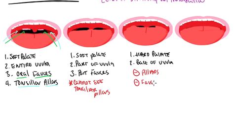 Modified Mallampati Classification