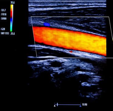 Understanding Arterial Doppler Ultrasound: A Comprehensive Guide ...