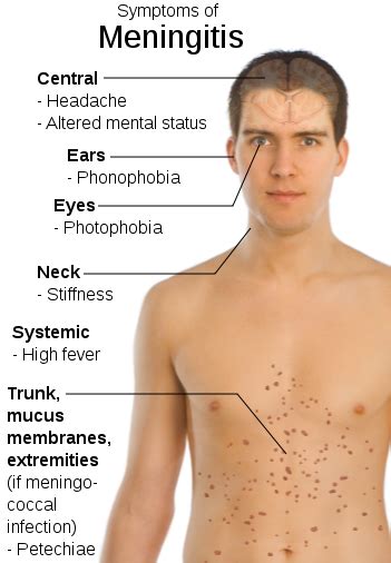 Meningococcemia history and symptoms - wikidoc