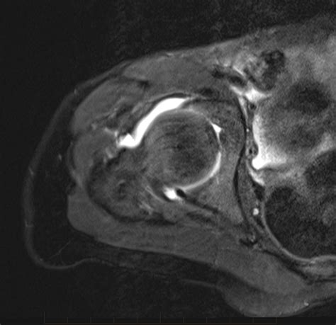 MRI Hip - Paediatic MRI Series - GP Referred