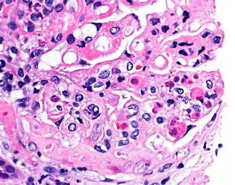 Hematoxylin Bodies In Lupus Nephritis Biopsy | Diagnose This!