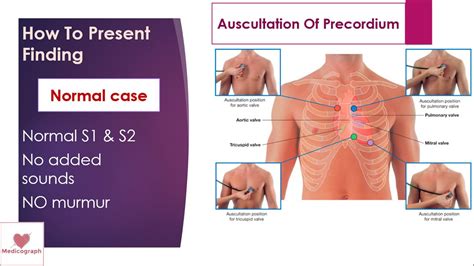 auscultation of precordium | examination of #precordium part 3 ...