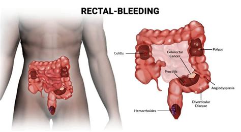 Bloody Diarrhea In Toilet