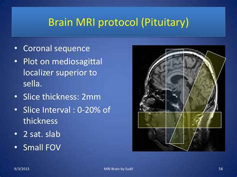 MRI Procedure of Brain