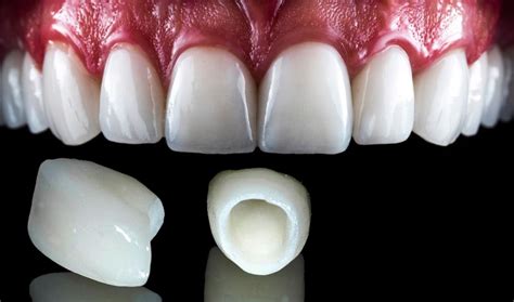 Difference Between Porcelain and Zirconia Crown