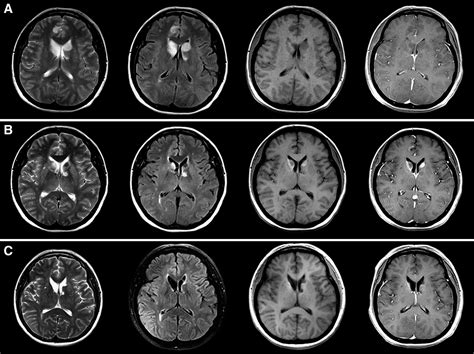 Time course of Hashimoto's encephalopathy revealed by MRI: Report of ...