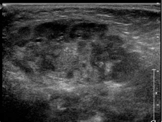 parotitis - Pediatric Imaging