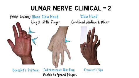 Hand Of Benediction Vs The Claw Hand The Ulnar Paradox] | atelier-yuwa ...