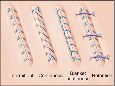 suture | Stitches medical, Surgical technologist student, Surgical suture