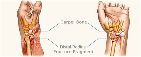 WRIST FRACTURE - Care2Cure Physiotherapy & Rehab Center