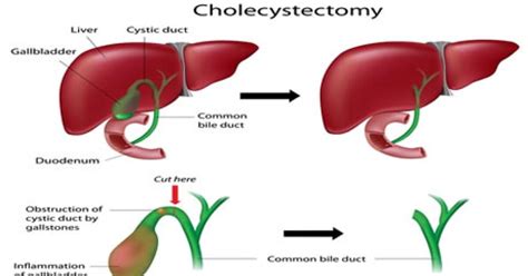 Cholecystectomy (Gallbladder Removal) : Conditions Treated, Procedure ...