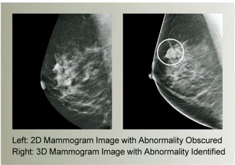 3D Mammography - Lake Medical Imaging - The Villages, Florida