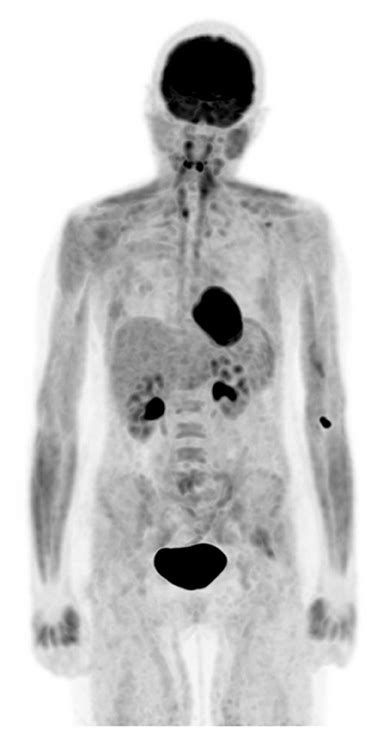 Pet Scan Images Of Lymphoma