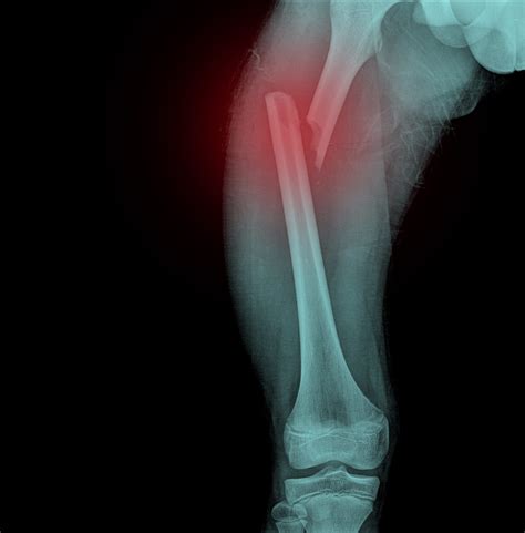 Physiotherapy after femur fracture surgery - little growing bones