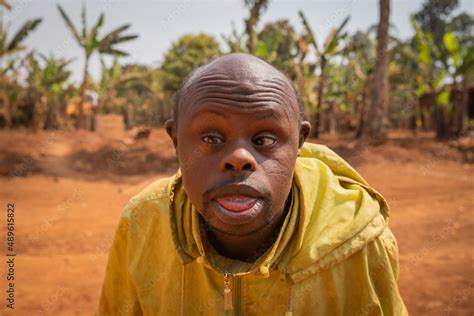 Portrait of an adult bald African man with Down syndrome, on a forest ...