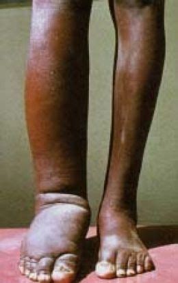 ELEPHANTIASIS CAUSES, SYMPTOMS, PREVENTION AND TREATMENTS