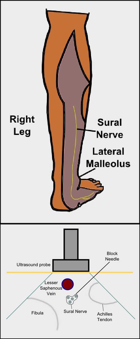 [Figure, Sural Nerve Block Figures Contributed by Ryan D'Souza, MD ...