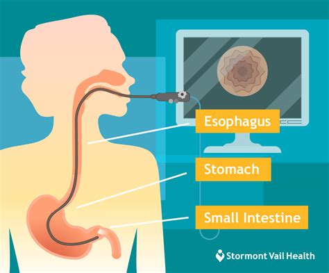 Endoscopy Procedure