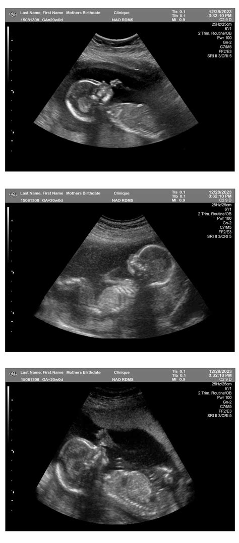 20 Week Pregnancy Ultrasound - Ultrasounds