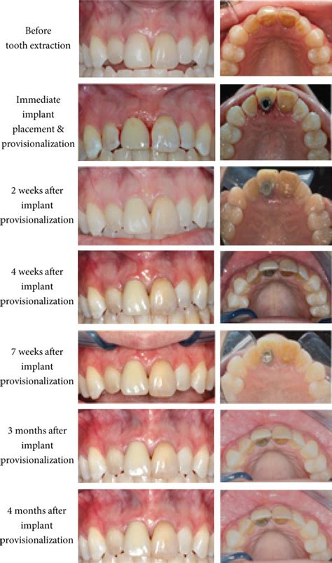 Clinical photos of tooth 11 before and after immediate implant ...