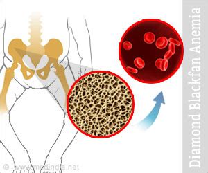 Diamond Blackfan Anemia: Symptoms, Causes, Treatment, Diagnosis