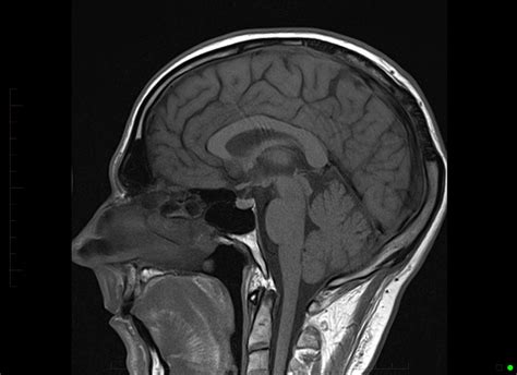 Pituitary Mri With Contrast