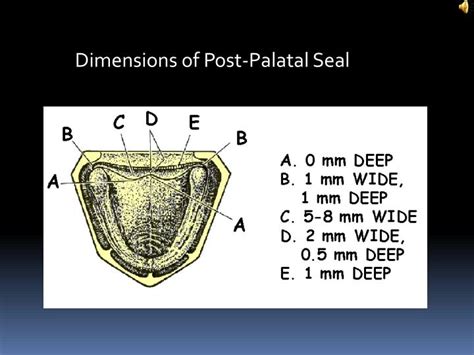 PPT - Posterior Palatal Seal PowerPoint Presentation - ID:826117