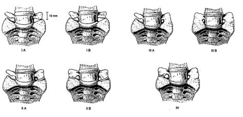 Lumbosacral Transitional Vertebra or LSTV | Bone and Spine