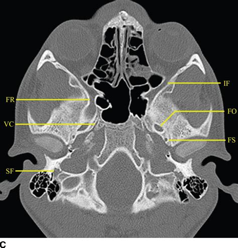 Sphenoid Bone Anatomy Ct