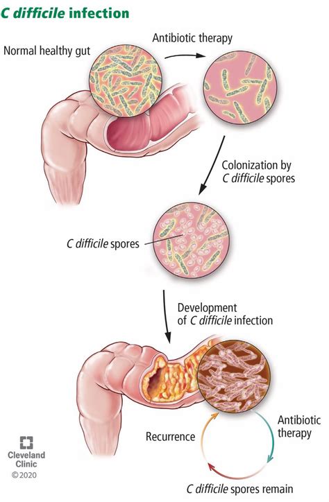 C-difficile spore - boxjawer