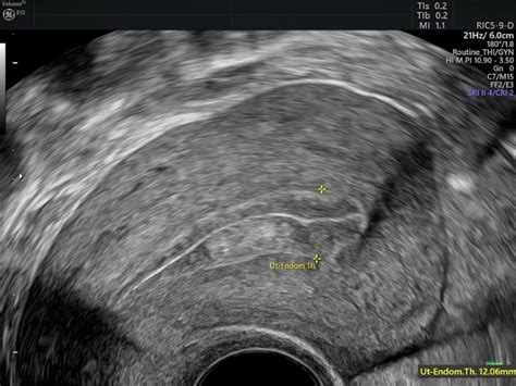 Making the Diagnosis With Endometrial Hyperplasia Ultrasound ...